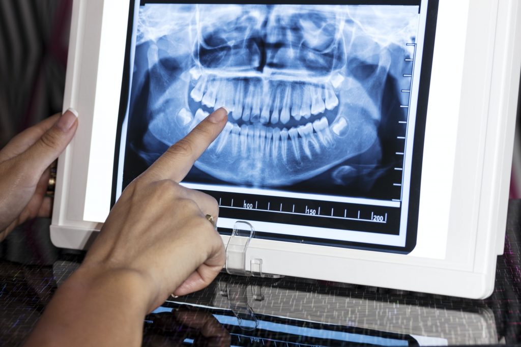 Dental Panoramic X-ray